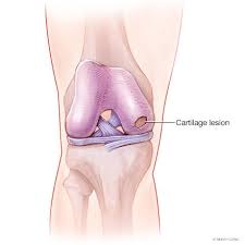 Cartilage Injuries